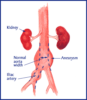 Abdominal Aortic Aneurysm
